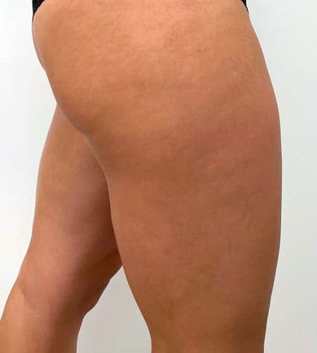 combatir la celulitis con tratamiento estético